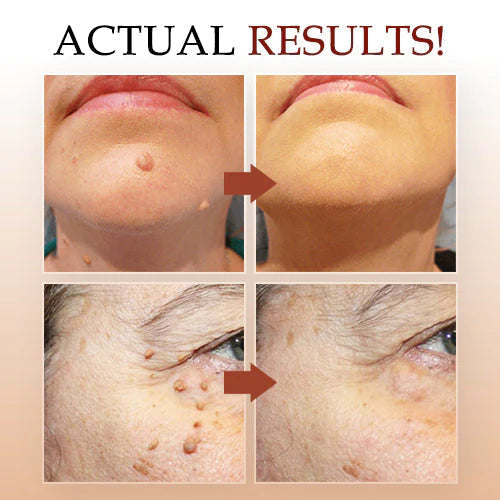 TagMo™ - Tags & Moles Remover (Buy 1 Get 1 Free🔥🔥)